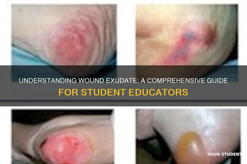 how to teach students about types of wound exudate