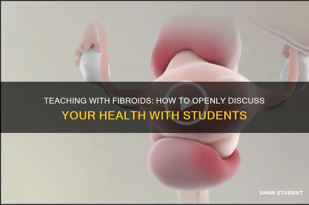 how to tell students you have fibroids teacher