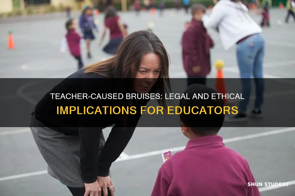 what happens if teacher caused bruise on student wi